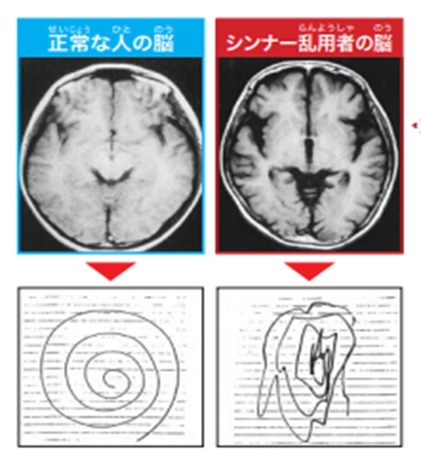 正常な人の脳とシンナーを使った人の脳