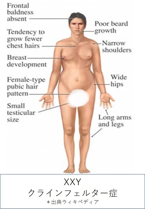 クラインフェルター症